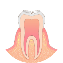 歯の表面に虫歯ができます
