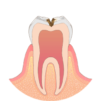 虫歯が神経に近くなり、冷たいものがしみます