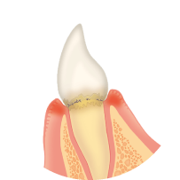 歯と歯ぐきの間に歯垢がたまります