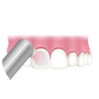歯の表面をツルツルに仕上げ磨き